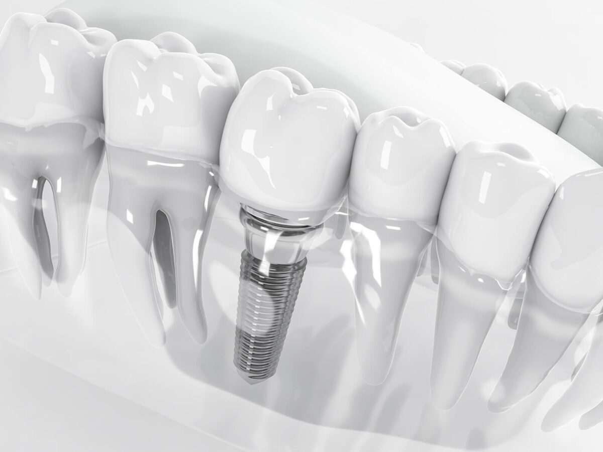 Dental Implants