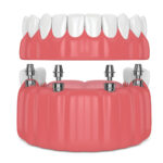 What To Expect With Overdenture Treatment