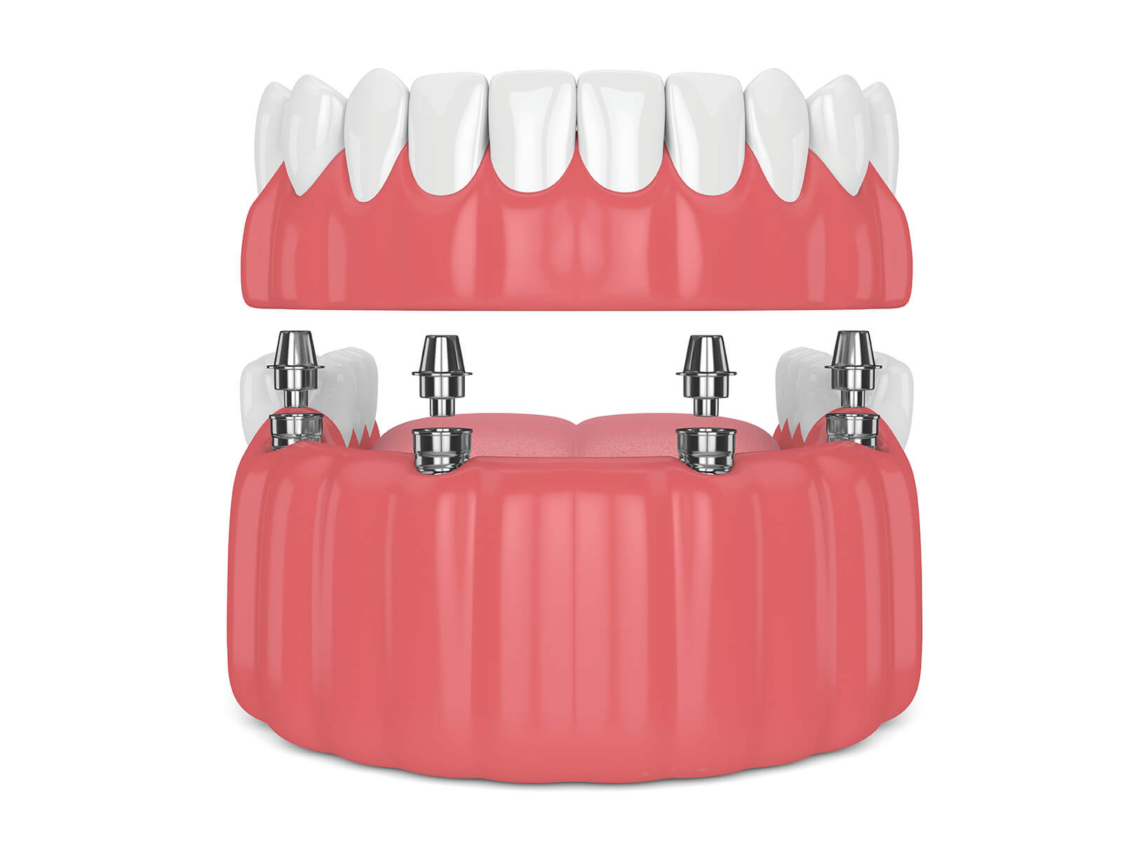 What To Expect With Overdenture Treatment