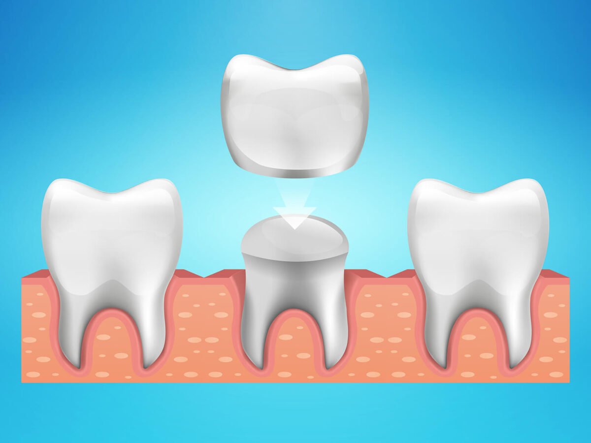 When A Dental Crown May Need To Be Replaced